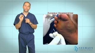 New Hammertoe Correction Procedure Performed in the Office [upl. by Allehs]