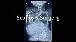 Scoliosis Surgery for Congenital Kyphoscoliosis [upl. by Cullin]