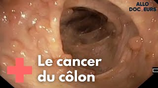 Cancer colorectal  quelle prise en charge   Allo Docteurs [upl. by Stilla]