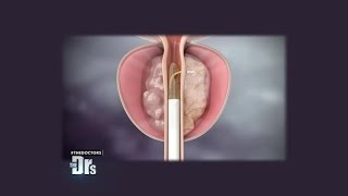 Dr Ordon’s Prostate Procedure [upl. by Doti43]