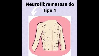 Neurofibromatose tipo I [upl. by Esiuqram721]