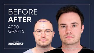 Hair Transplant in Turkey  Results  Dr Acar  Cosmedica Clinic [upl. by Armil]