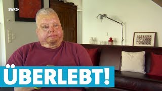 Bernhard überlebt FlugzeugExplosion trotz schwerer Verbrennungen [upl. by Yellehs784]