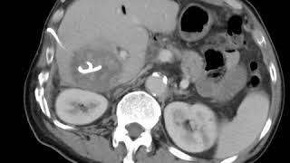 HBP C3 Liver Percutaneous drainage [upl. by Adekam]