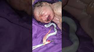 Vernix lot of 2 meters Newborn baby nurse and doctor cleaning it with soap and spinal cords cutt [upl. by Tiffanle281]