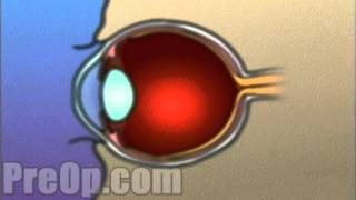 Laser Eye Surgery PRK PreOp® Patient Engagement and Education [upl. by Dare367]