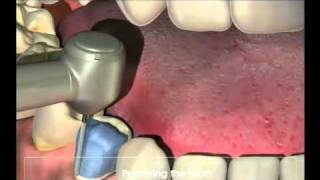 Crowns  Procedure for your new crown at Dental Reflections [upl. by Rosenblast555]