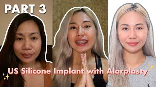 Part 3 Rhinoplasty Journey  KOSMED Clinic US Silicon with Alarplasty [upl. by Kern]