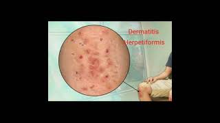 🍁 Dermatitis Herpetiformis 🍁 [upl. by Schrick]