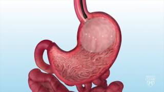 Intragastric Balloon for Weight Loss  Mayo Clinic [upl. by Mackay]