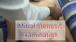 Mitral stenosis examination  murmur examination  sanowarhossain1290 [upl. by Enelyk]