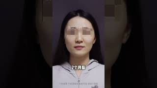 只是做了颧骨降低，2个月我妈都不认识我了！！！变美我熟 整容 cheekbones zygomaticimplants short [upl. by Leyla484]