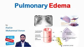 Pulmonary Edema  Pulmonary Interstitial Fluid formation  Safety Factor  Physiology of Respiration [upl. by Bowers]