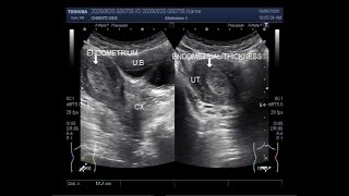 Ultrasound Video showing Endometrial hyperplasia in 33 years old female [upl. by Taylor]