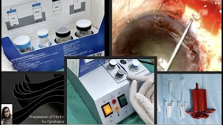 A step by step guide as to how to prepare and use the fibrin glue Tiseel in ophthalmic surgeries [upl. by Acinorehs]