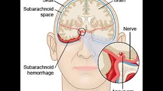 Subarachnoid Hemorrhage [upl. by Geneva]