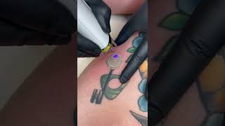 Watch Tattoos Fade with the Enlighten III Laser [upl. by Tray845]