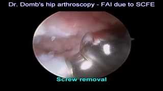 FAI after SCFE screw removal and osteoplasty  Hip arthroscopy [upl. by Hynes197]