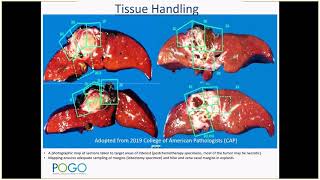 CAP education session Pediatric Hepatoblastoma Dr El Demellawy 2019 [upl. by Atinav903]