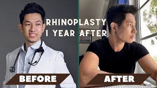 MY RHINOPLASTY amp CHIN AUGMENTATION JOURNEY  Dr Henry Claravall amp Dr Romeo Bato [upl. by Enetsirk244]