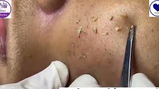 Extracting Closed Comedones on the Forehead Episode 1 acne blackheadswhiteheads Treatments [upl. by Bernardine]