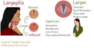 Laryngitis  a patient education video [upl. by Lissa]