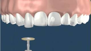 Dentistry Recontouring Teeth 1 [upl. by Enitnemelc]