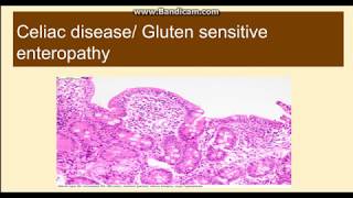 Celiac diseaseGluten Sensitive Enteropathy [upl. by Aisat206]