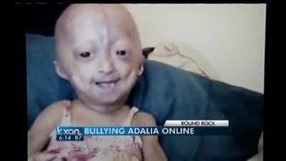 Cyber bullying of child with rare disease [upl. by Rockwood]