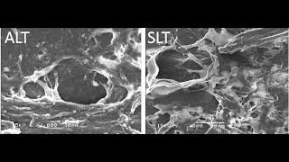 Selective Laser Trabeculoplasty Tips and Tricks Malik Y Kahook MD [upl. by Ciprian62]