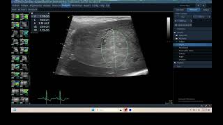 IQ 306 LIVER HEPATOMA ULTRASOUND ECHOPAC ANALYSIS [upl. by Blakeley729]