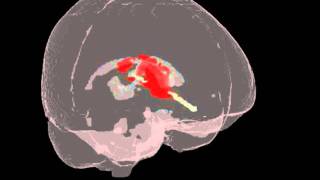 MISTIE Intracranial Hemorrhage ICH Thrombolytic Reduction using rtPA [upl. by Tennaj]