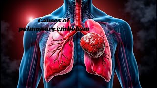 What causes pulmonary embolism Understanding the risks [upl. by Rist]