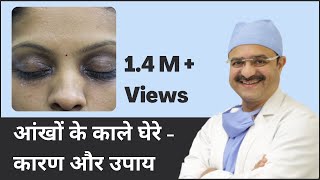 आंखों के काले घेरे  कारण और उपाय Under Eye Dark Circles Causes amp Treatments  In HINDI [upl. by Rovner936]