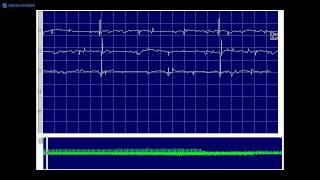 Kimura amp Kohara F21 positive sharp waves and fibrillation potentials each firing regularly [upl. by Manbahs]