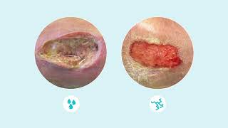 How to assess wound exudate [upl. by Jewel]