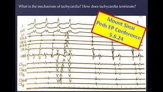 Mount Sinai Pediatric EP Conference 5624 [upl. by Suaeddaht]