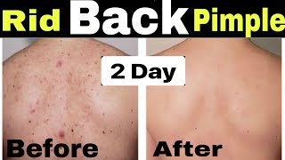 How to Remove Back Acne and PimplesGet Rid of Back amp Body Acne PimpleBack acne treatment [upl. by Biggs]