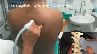 Realtime Ultrasound guided Thoracic epidural insertion [upl. by Mattheus]