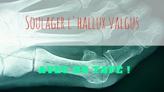 Soulager un Hallux valgux avec du KTape [upl. by Cantone]