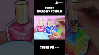 ASMR Funny Ingrown Toenail Removal shorts stopmotion seegichannel asmr [upl. by Mccafferty]