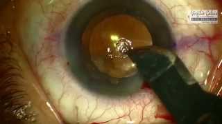 Fresado corneal por leucoma [upl. by Irolav895]