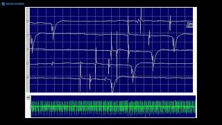 Kimura amp Kohara F18 Transition of positive sharp waves to fibrillation potentials [upl. by Novit322]