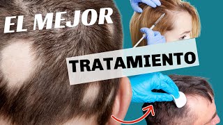 ALOPECIA AREATA 6 COSAS QUE NO SABIAS [upl. by Raila]