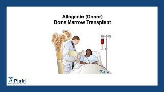 Allogenic Donor Bone Marrow Transplant [upl. by Llerrud]