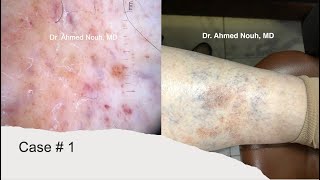 Pigmented purpuric dermatoses Dermatological spectra [upl. by Aicire]