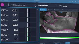 AlignRT Advance Breath Hold Overview [upl. by Udela]