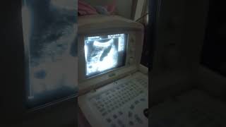 abdominal ultrasound cirrhotic liver cholecystitis with cholelithiasisshortvlog [upl. by Anatnom]