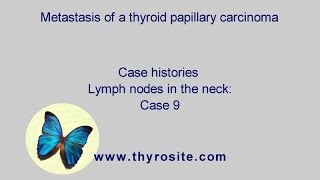 Metastasis of a papillary thyroid cancer Lymph nodes in the neck  case 9 [upl. by Giliane]