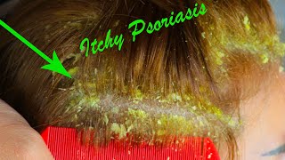 Dandruff Removal With Comb Satisfying  Big Flakes Scalp Scratching And Picking 251 [upl. by Ruhtra]